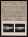 Upper Limb. Surface Anatomy - no. 5